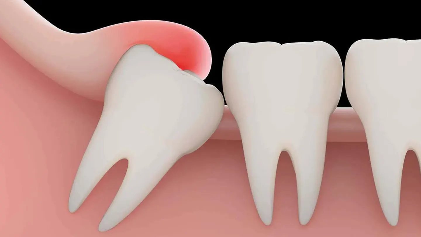 Gömülü 20’lik Diş Çekimi Nasıl Yapılır?