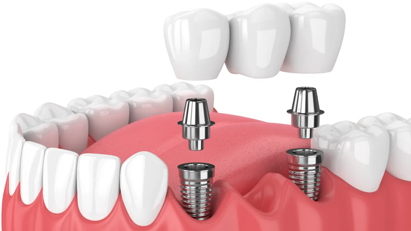 İmplant Nedir? Diş İmplantı Tedavisi Nasıl Yapılır?