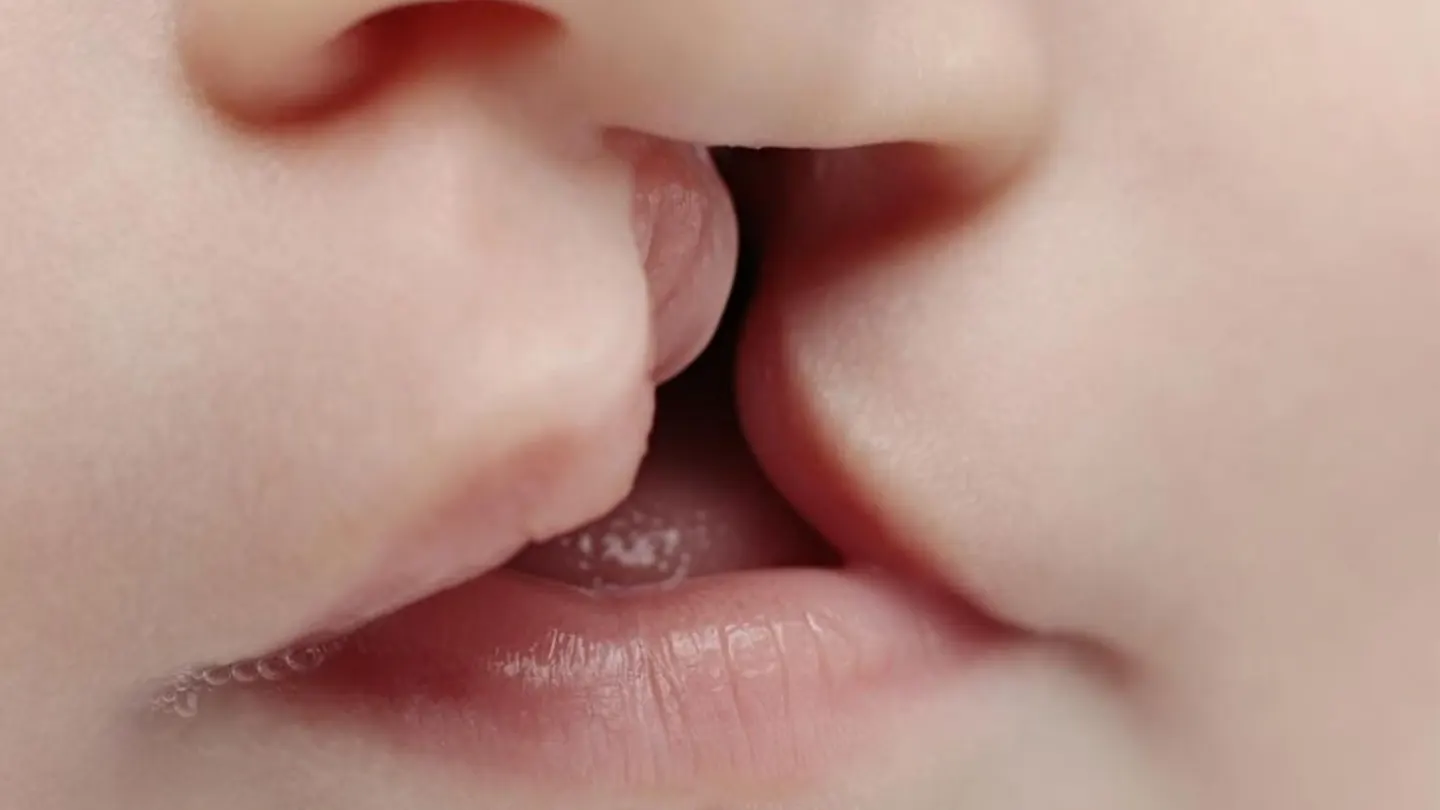 Tavşan Dudak (Yarık Dudak – Yarık Damak) Nedir?