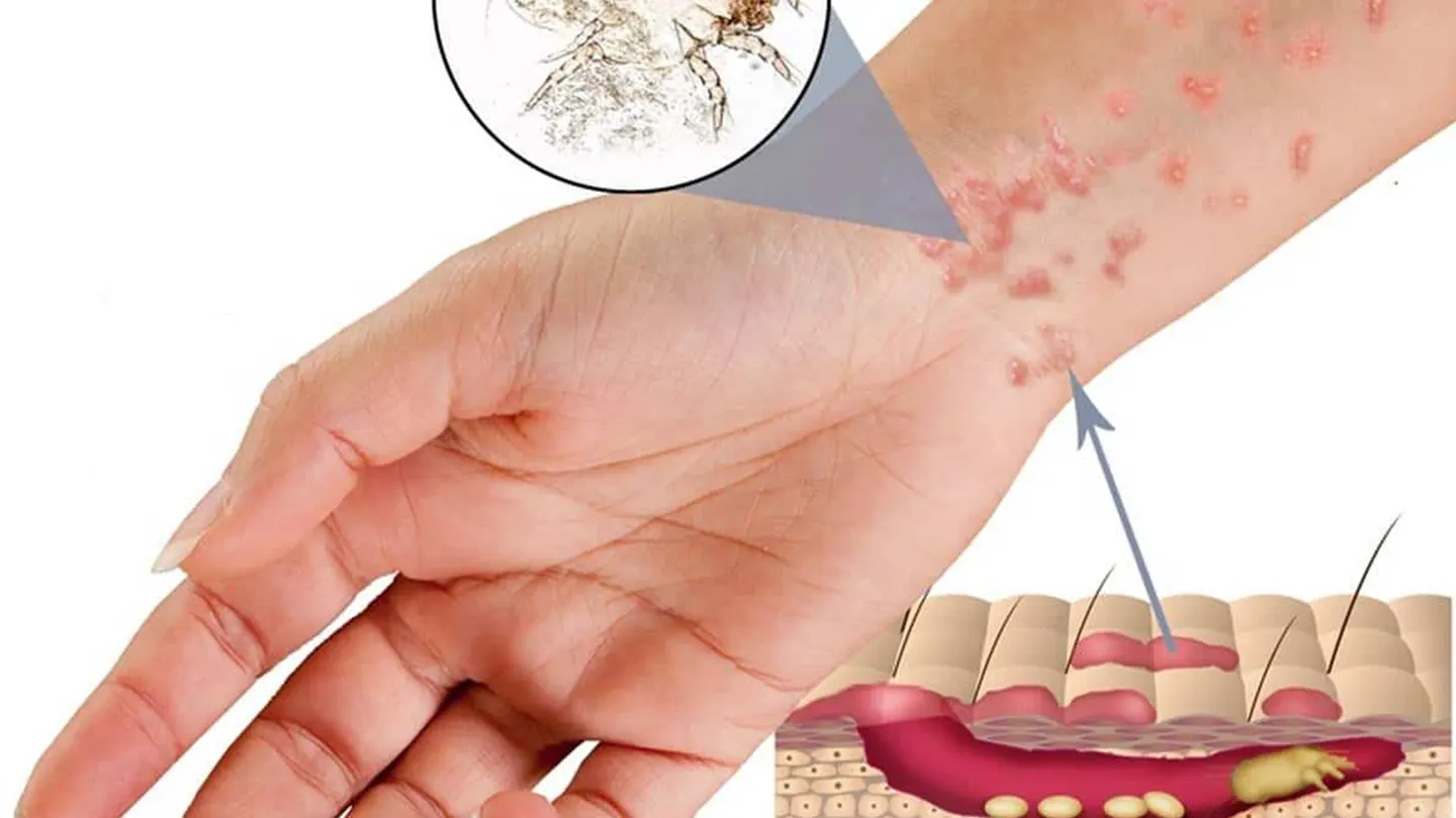 Uyuz Hastalığı Nedir?