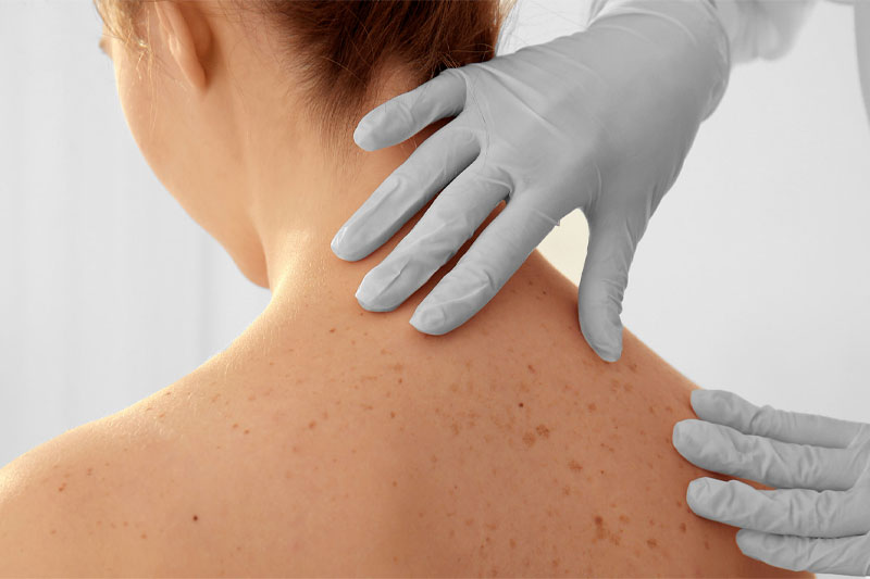 DERMATOLOJİ